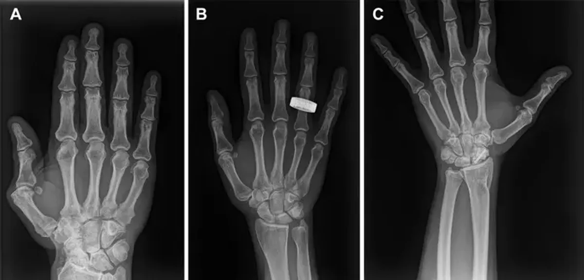 First In-Space Human X-rays Achieved on Fram2 Mission